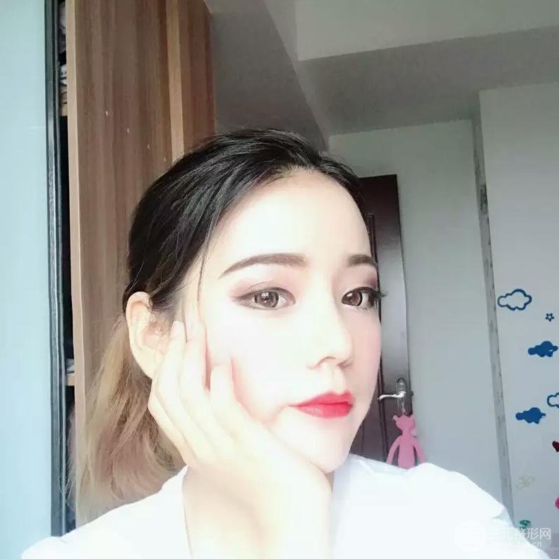 硅膠隆鼻+自體耳軟骨墊鼻尖案例前后對(duì)比照片分享