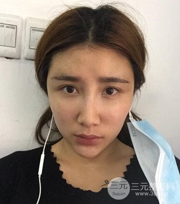 網(wǎng)絡主播做自體脂肪豐太陽穴真實案例分享，果杠杠的