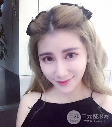 網(wǎng)絡主播做自體脂肪豐太陽穴真實案例分享，果杠杠的