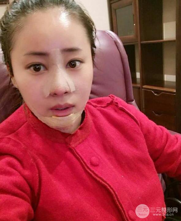 成都華顏賈德淵隆鼻失敗修復(fù)真實(shí)案例分享，并且附上前后對(duì)比照片