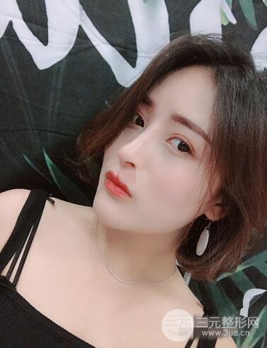 上海李鴻君隆鼻果圖片恢復(fù)日記分享