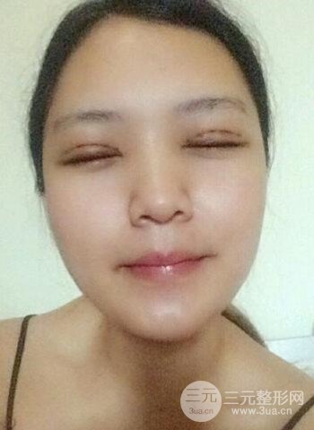 深圳雙眼皮正就內(nèi)雙小眼睛，真實(shí)案例前后對(duì)比照片