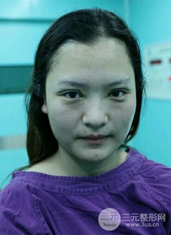 深圳雙眼皮正就內(nèi)雙小眼睛，真實(shí)案例前后對(duì)比照片