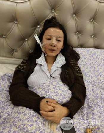 廣州隆鼻整形+全臉自體脂肪填充真人案例果分享