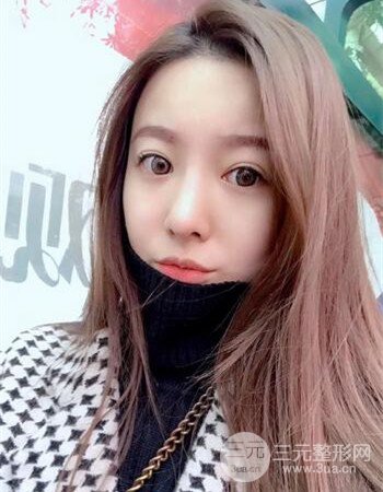 廣州隆鼻整形+全臉自體脂肪填充真人案例果分享