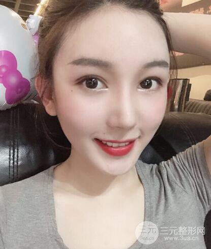 蘇北人民醫(yī)院李平松雙眼皮案例日記