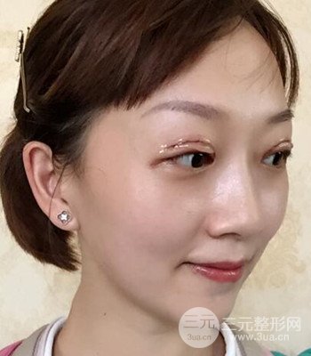 北京雙眼皮失敗修復(fù)手術(shù)日記分享，附上前后對比照片