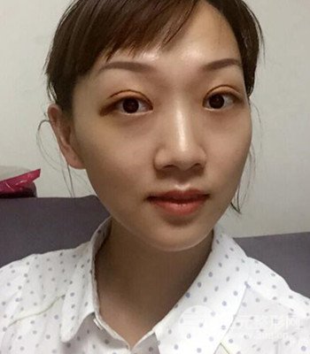 北京雙眼皮失敗修復(fù)手術(shù)日記分享，附上前后對比照片
