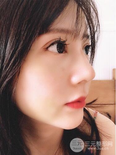 夏正義做鼻子怎么樣？隆鼻案例日記記錄