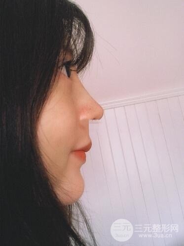 夏正義做鼻子怎么樣？隆鼻案例日記記錄