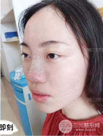 廣州博仕隆鼻失敗修復(fù)案例，前后恢復(fù)過程分享~