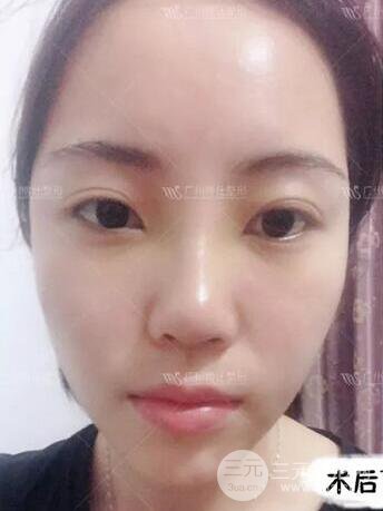 廣州博仕隆鼻失敗修復(fù)案例，前后恢復(fù)過程分享~