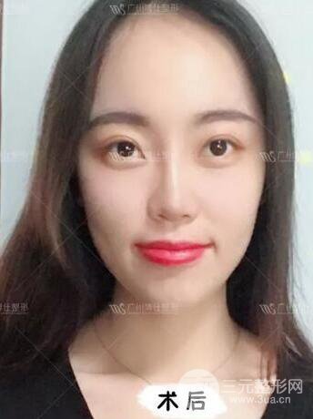 廣州博仕隆鼻失敗修復(fù)案例，前后恢復(fù)過程分享~