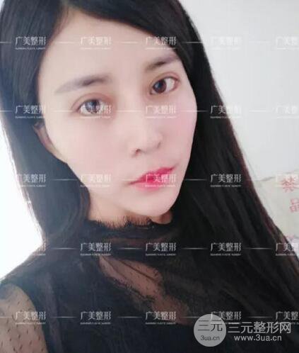 廣州廣美李曉平醫(yī)生雙眼皮整形日記分享