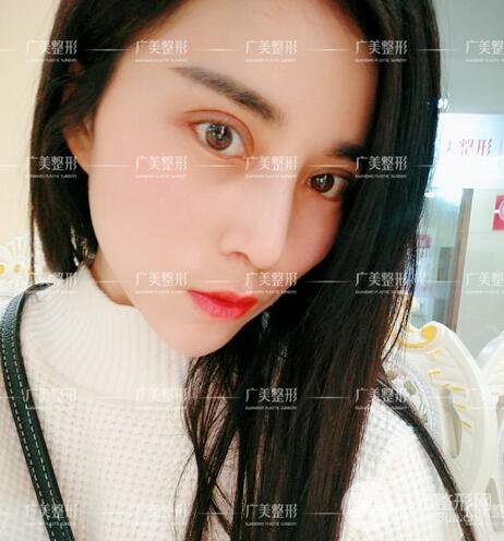 廣州廣美李曉平醫(yī)生雙眼皮整形日記分享