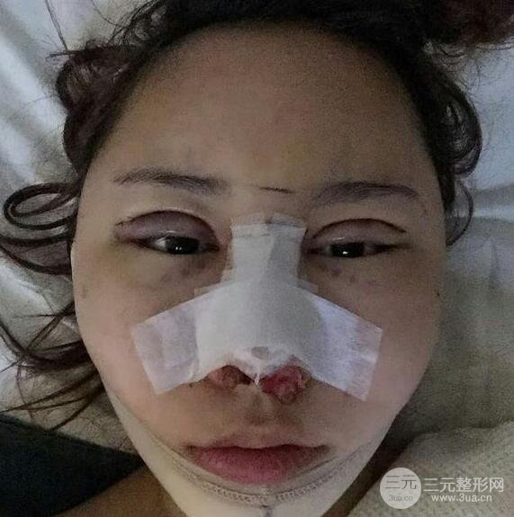 青島伊美爾國賓切開雙眼皮+隆鼻整形+硅膠墊下巴案例分享，附上前后對比照片