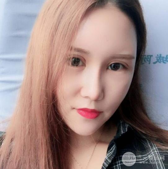 青島伊美爾國賓切開雙眼皮+隆鼻整形+硅膠墊下巴案例分享，附上前后對比照片