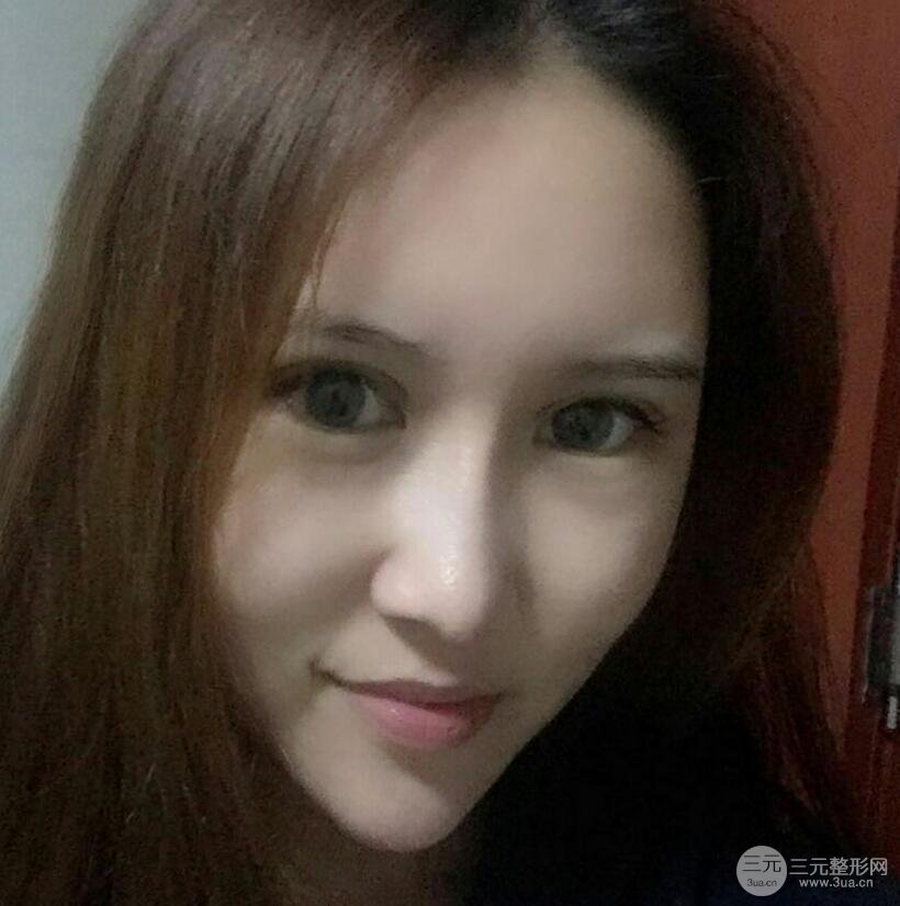 青島伊美爾國賓切開雙眼皮+隆鼻整形+硅膠墊下巴案例分享，附上前后對比照片