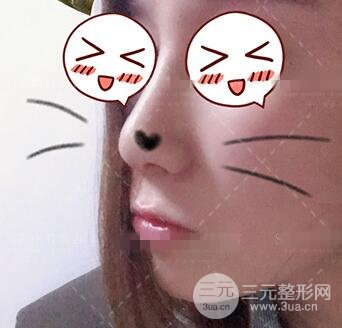 肖征剛做鼻子隆鼻案例恢復果圖日記