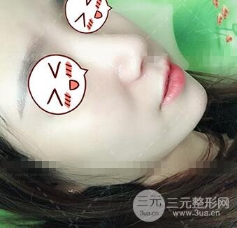 肖征剛做鼻子隆鼻案例恢復果圖日記