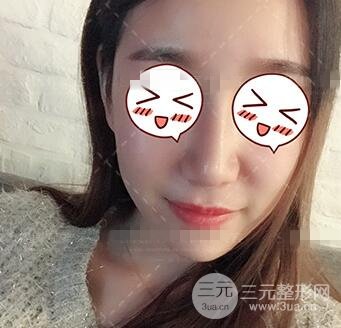 肖征剛做鼻子隆鼻案例恢復果圖日記