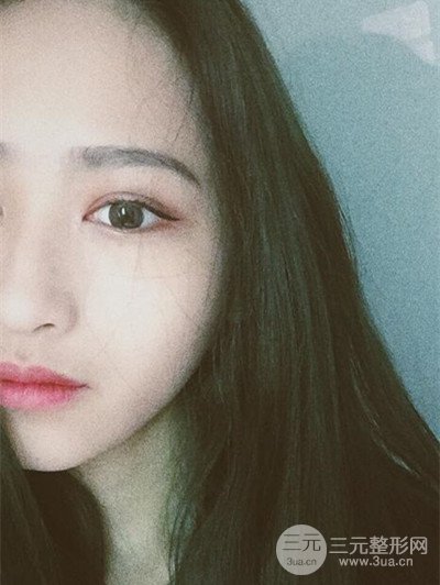 廣州曙光劉杰偉醫(yī)生切開雙眼皮案例，前后對比圖分享