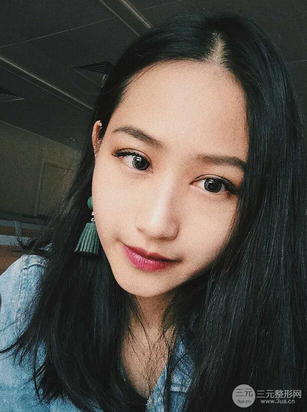 廣州曙光劉杰偉醫(yī)生切開雙眼皮案例，前后對比圖分享