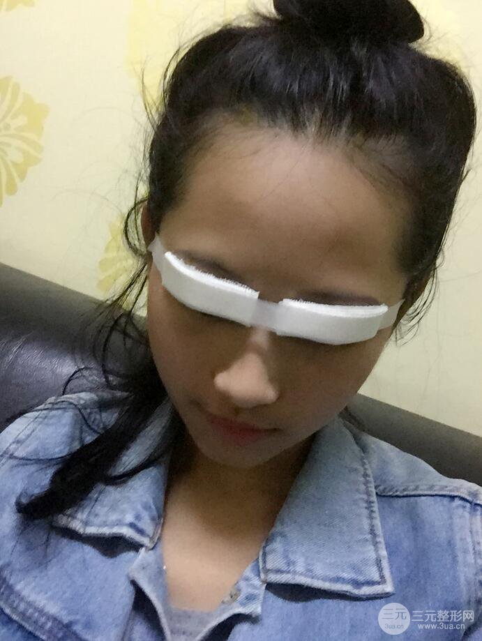 廣州曙光劉杰偉醫(yī)生切開雙眼皮案例，前后對比圖分享