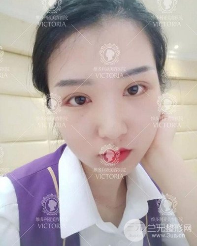 南京維多利亞切開雙眼皮+開眼角案例分享，附上前后對比圖