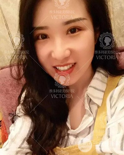 南京維多利亞切開雙眼皮+開眼角案例分享，附上前后對比圖