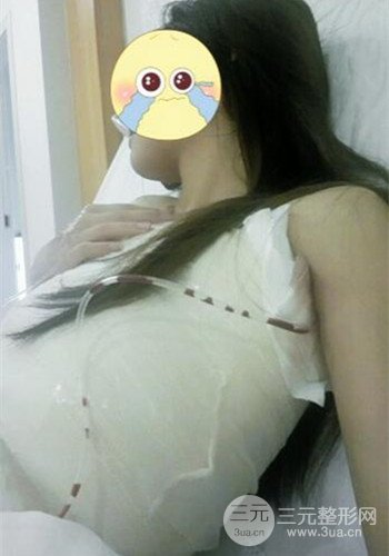 深圳假體隆胸讓平胸妹華麗變身，手術(shù)果分享