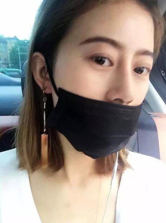 成都心悅容倪云志假體隆鼻前后恢復過程分享