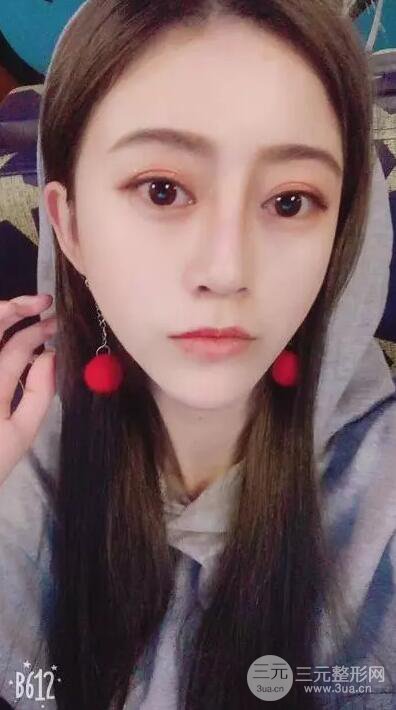 成都心悅容倪云志假體隆鼻前后恢復過程分享