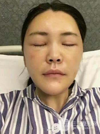 主播在深圳美臣做了自體脂肪全臉填充手術(shù)日記分享