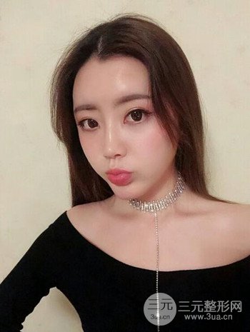 主播在深圳美臣做了自體脂肪全臉填充手術(shù)日記分享