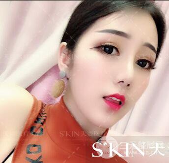 汪海濱雙眼皮+隆鼻案例術(shù)后100天日記~