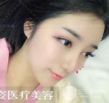 汪海濱雙眼皮+隆鼻案例術(shù)后100天日記~