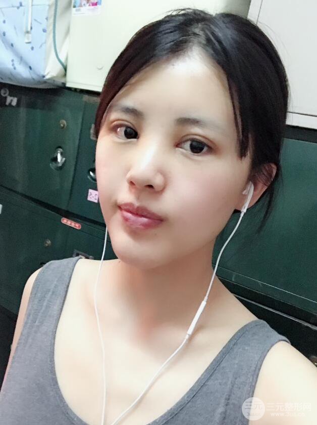 北京禾美嘉任學(xué)會自體脂肪面部填充案例分享