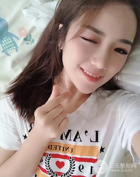 廣州海峽軍隆鼻失敗修復(fù)案例術(shù)后記錄