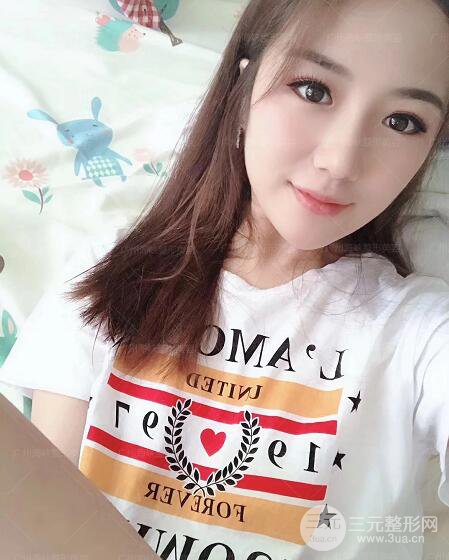 廣州海峽軍隆鼻失敗修復(fù)案例術(shù)后記錄