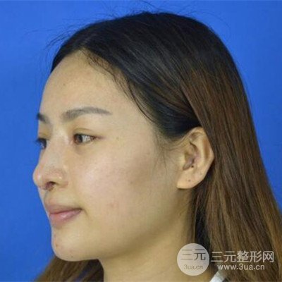 廣州藝美李闖醫(yī)生隆鼻整形恢復(fù)記錄分享~