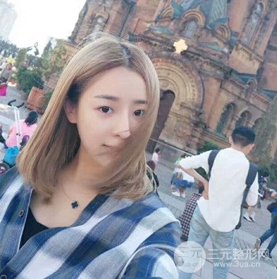 廣州藝美李闖醫(yī)生隆鼻整形恢復(fù)記錄分享~