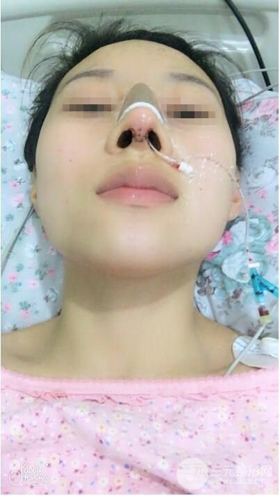 武漢亞太程曉林做鼻子好嗎？隆鼻案例日記