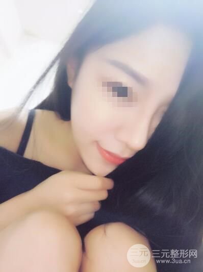 武漢亞太程曉林做鼻子好嗎？隆鼻案例日記