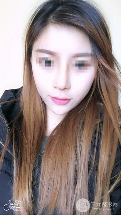 武漢亞太程曉林做鼻子好嗎？隆鼻案例日記