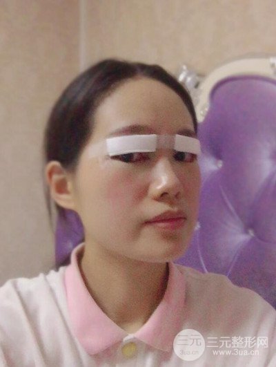 廣州晨曦切開雙眼皮恢復(fù)日記分享，附上前后對比圖