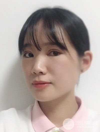 廣州晨曦切開雙眼皮恢復(fù)日記分享，附上前后對比圖