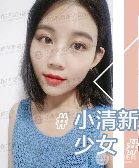 四川華美紫馨自體脂肪面部案例術(shù)后恢復(fù)日記