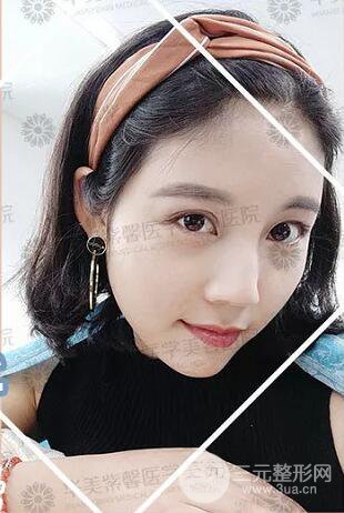 四川華美紫馨自體脂肪面部案例術(shù)后恢復(fù)日記