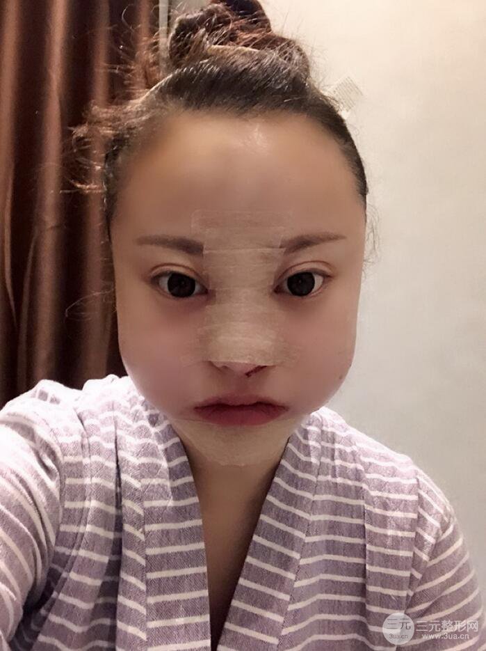 太原麗都面部吸脂+假體隆鼻案例分享，精致面部小V臉了解一下~